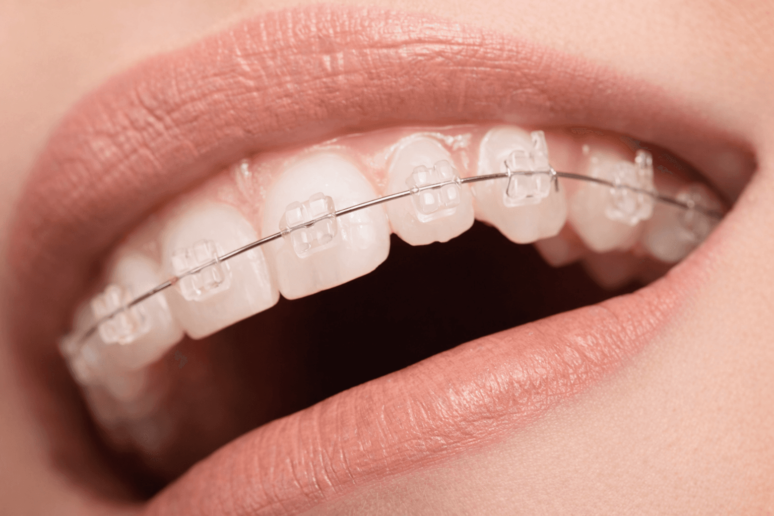 Clear Braces