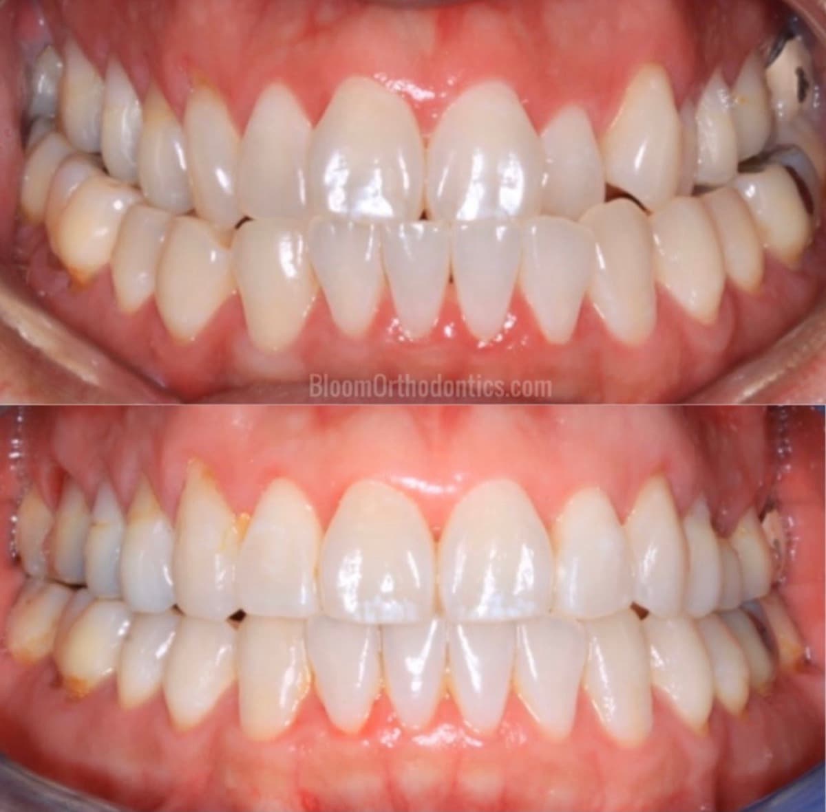 Bite Alignment — before and after